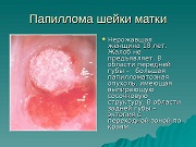 Папиллома на втнутренних органах 