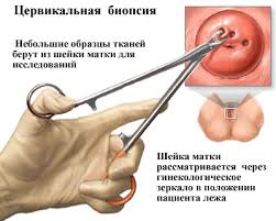 биопсия папилломы