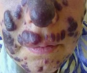 болезни кожи при вич