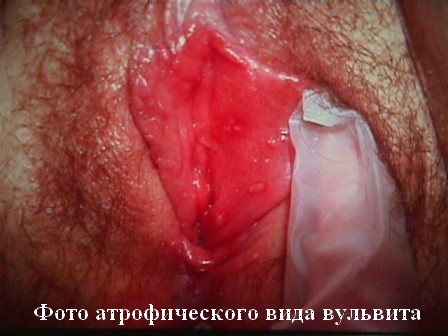 фото атрофического вида вульвита у женщин