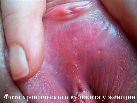 фото хронического вульвита у женщин