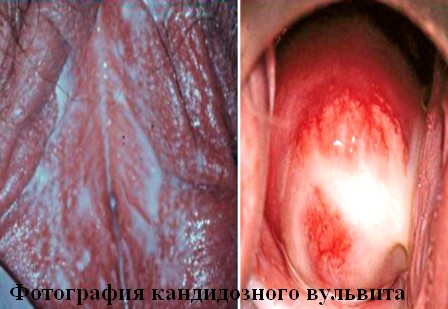 фото кандидозного вульвита у женщин