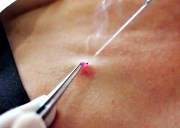 лекарства от остроконечных кондилом