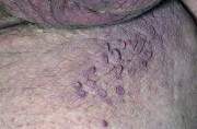можно ли прижигать папилломы