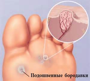 папиллома на ноге фото
