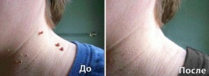 папинол от папиллом отзывы