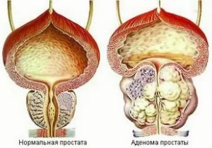 простафор от простатита отзывы