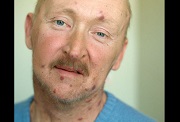 проявление вич инфекции