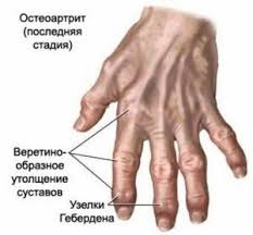 псориаз костей