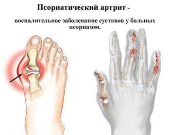 псориаз суставов