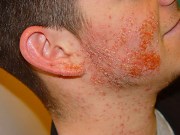 пятна при вич инфекции