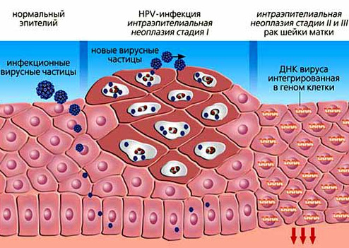 впч 3