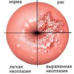 впч и эрозия