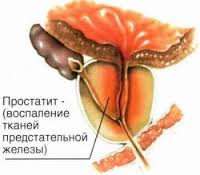 Последствия трихомонады у мужчин