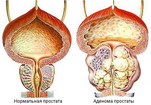 Чем отличается аденома от простатита