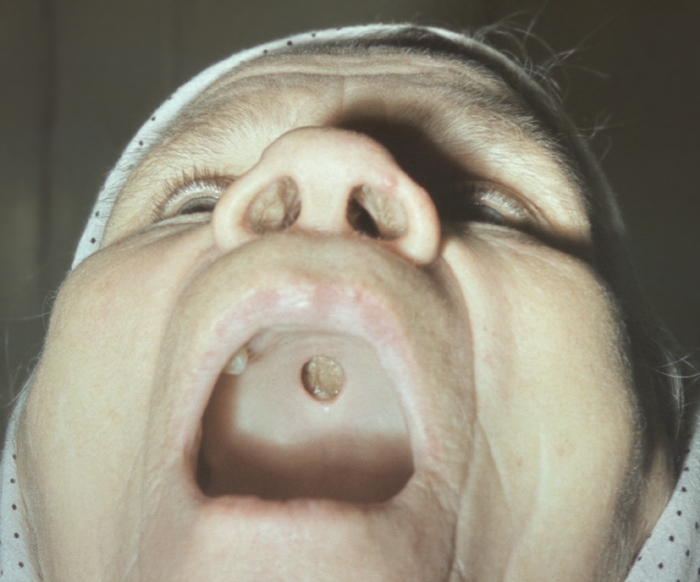 Сифилитическая гумма