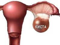контрацептивы при кисте