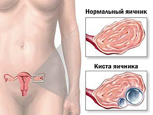 противозачаточные киста
