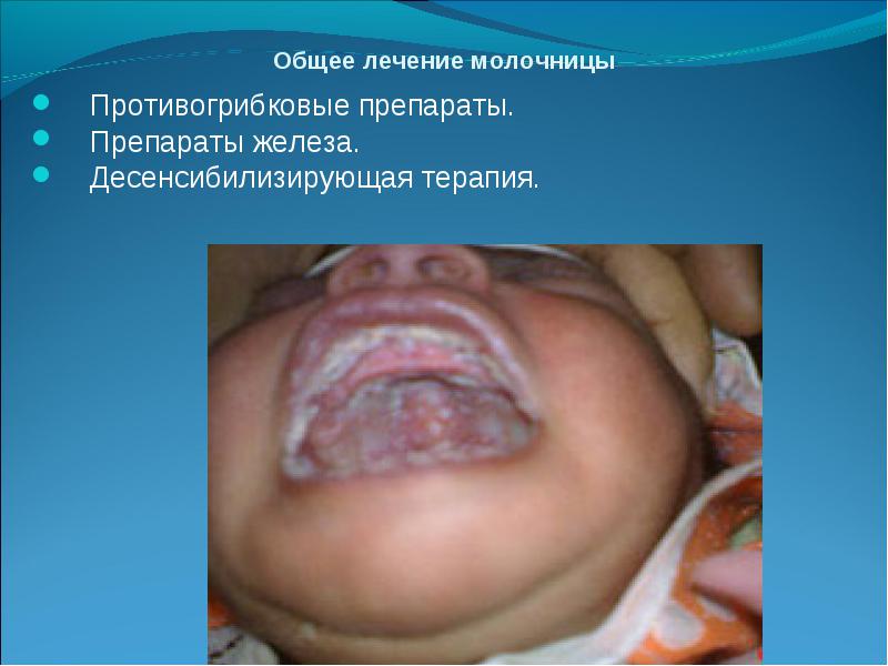 Лечение молочницы у детей