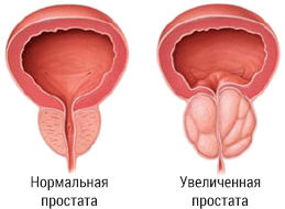 Массажер простаты для лечения простатита
