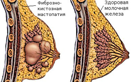 противозачаточные при мастопатии