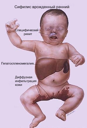 Наследственный сифилис