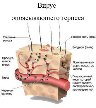 Причины опоясывающего герпеса