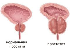 Причины простатита