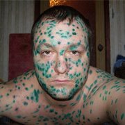 ветрянная оспа герпес